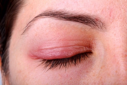 Hollywood, FL Pharmacy Could Be Responsible For Outbreak of Eye Infections