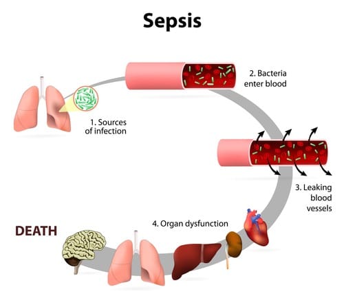 New Study Shows Older Patients at High Risk of Developing Sepsis