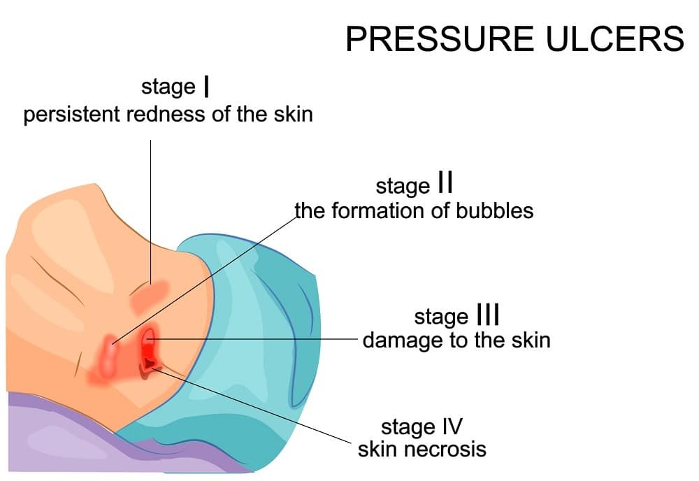 What is a Pressure Sore?
