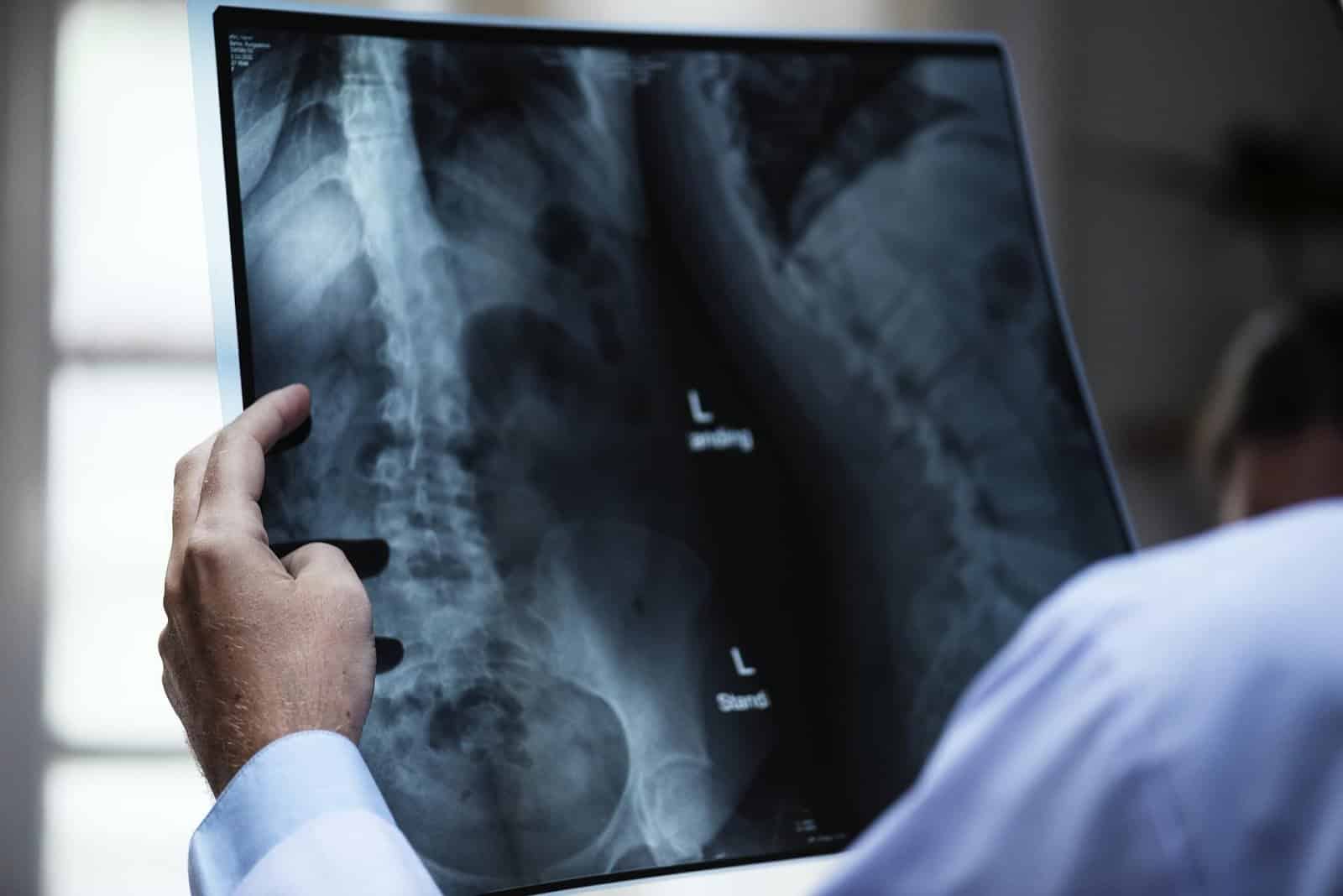 Spinal Cord Injuries: Everything You Need to Know