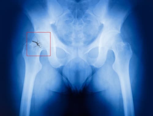 tampa-broken-hips-or-pelvis-lawyer-injuries-after-falling