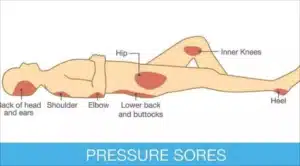Pressure sore