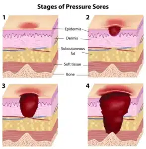 stages of bed sores